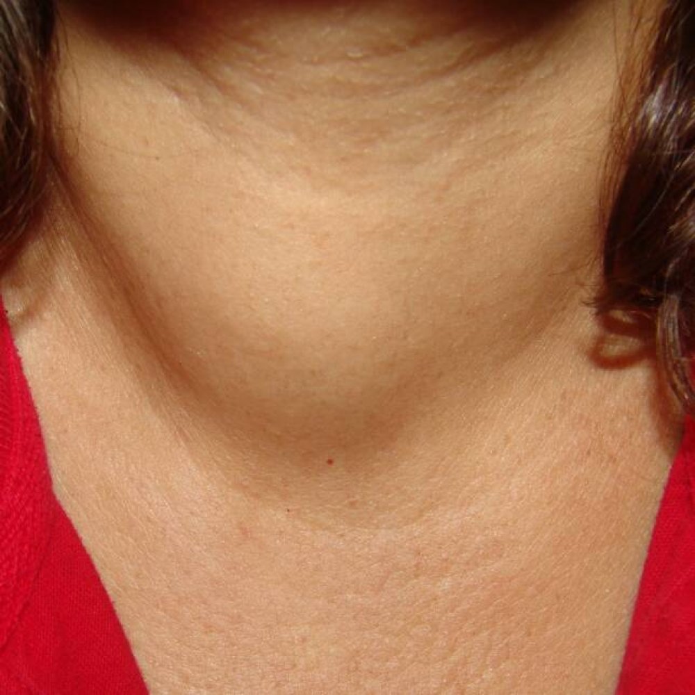 Как выглядит увеличенная щитовидка у женщин фото